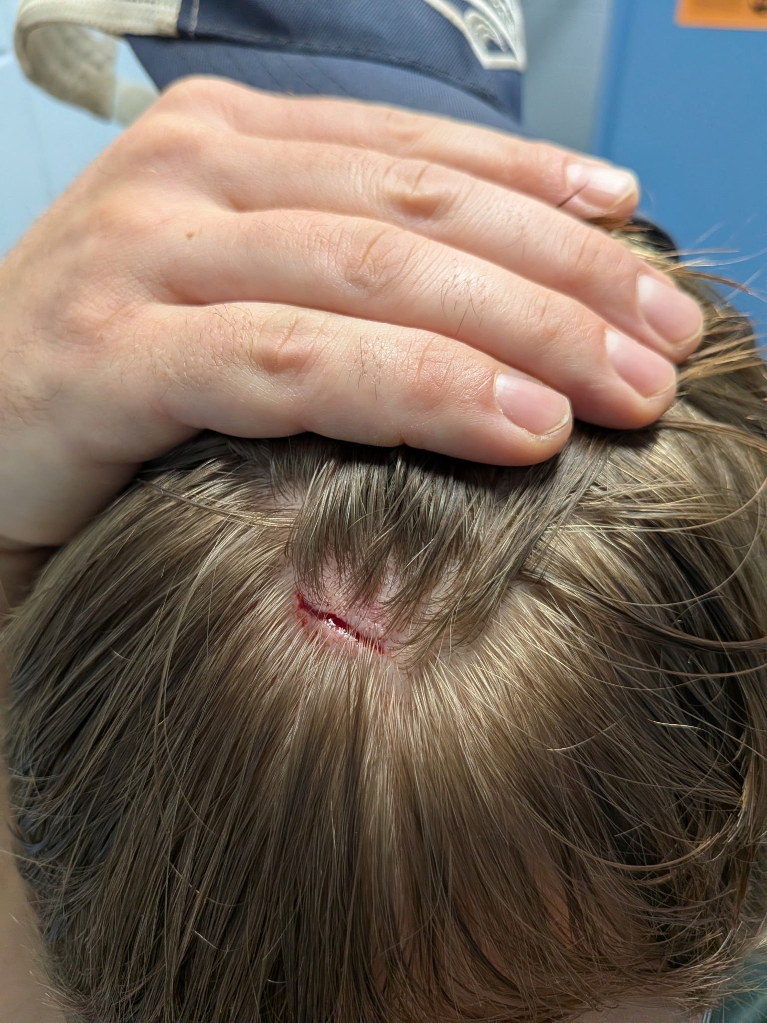 Nic's wrench-induced head wound